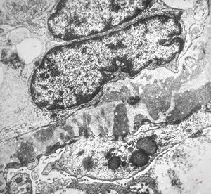 F,26y. | membranous glomerulopathy F,26y. | membranous glomerulopathy